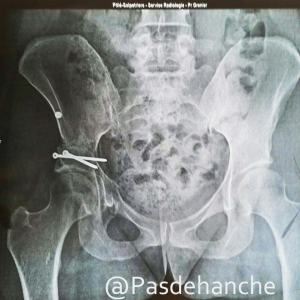 radio-post-op-3mois-osteotomie-periacetabulaire-@pasdehanche